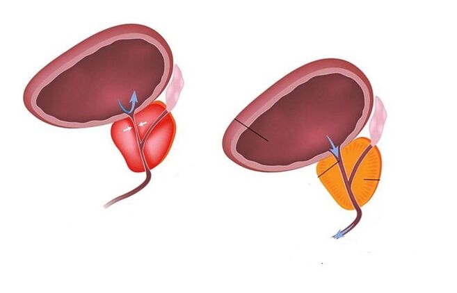 prostate saine et malade