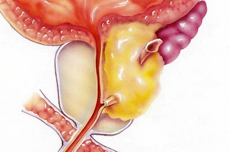 Inflammation de la prostate